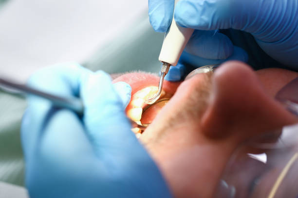 Best Emergency Dental Care for Broken or Chipped Teeth in Ada, OH